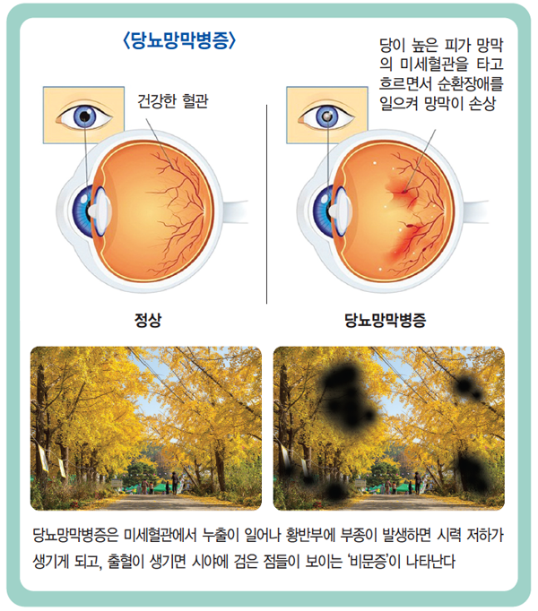 당뇨 합병증으로 망막 손상되는 ‘당뇨망막병증’의 증상과 치료