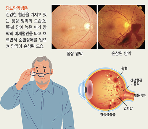 당뇨병 오래될수록 위험 높아지는 ‘당뇨망막병증’의 증상과 치료