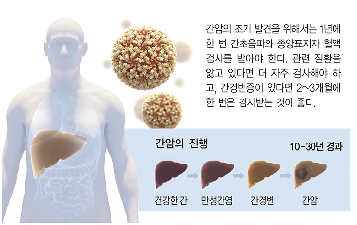 간암 환자 80%는 간경변이 원인… 주기적 검진 필요
