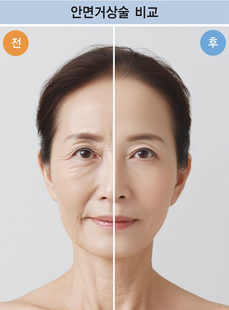 처지고 주름진 조직을 위로 당겨 탄력 있는 얼굴로 되돌리는 거상술은 얼굴과 이마, 목 등 노화가 잘 나타나는 부위에 시행하면 자연스럽고 효과적인 결과를 얻을 수 있다. 사진은 안면거상술을 받은 환자의 수술 전(왼쪽)과 수술 후(오른쪽)의 모습. 사진=게티이미지뱅크