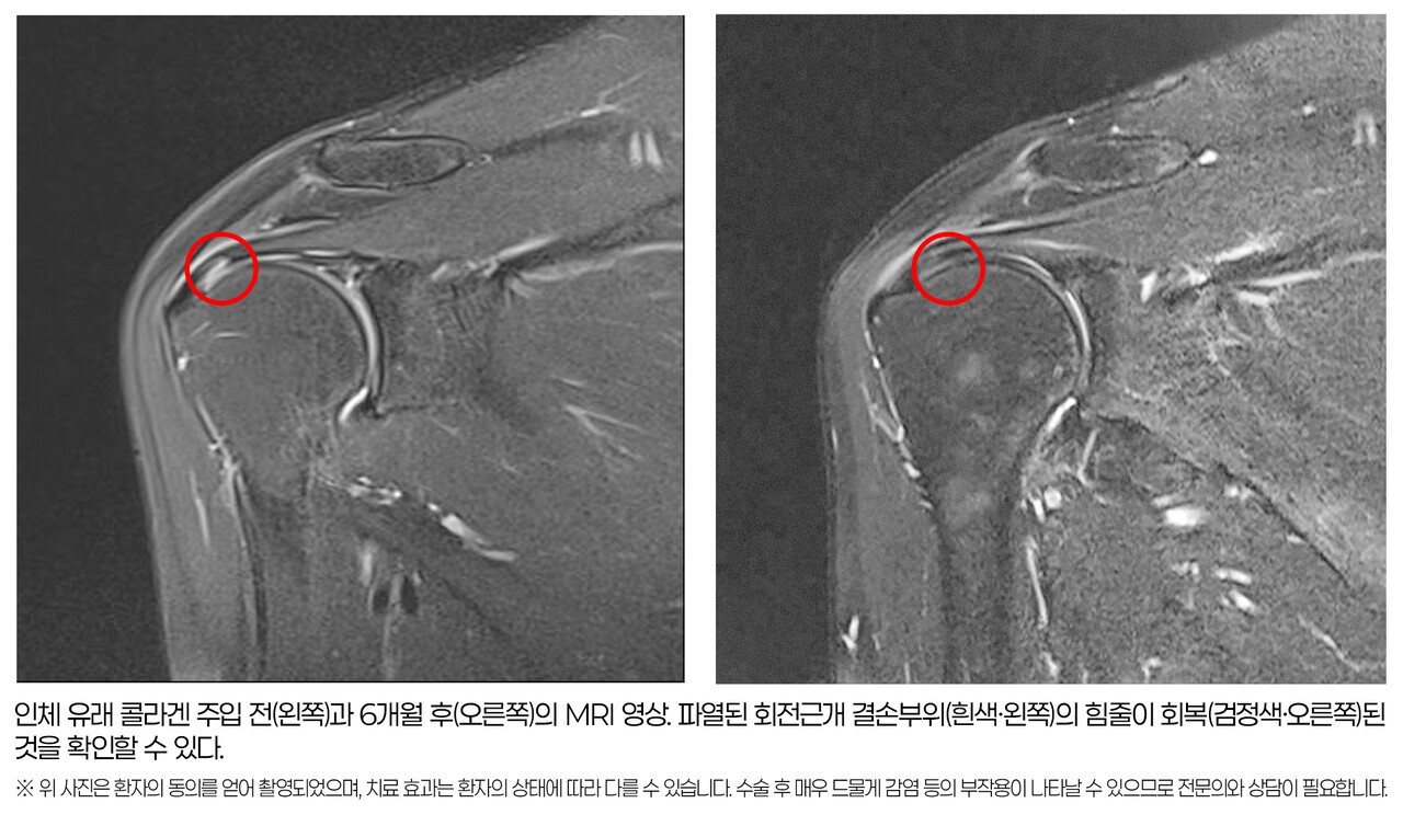 힘찬병원 “회전근개 부분 파열 ‘콜라겐 주입’ 치료 효과 확인”